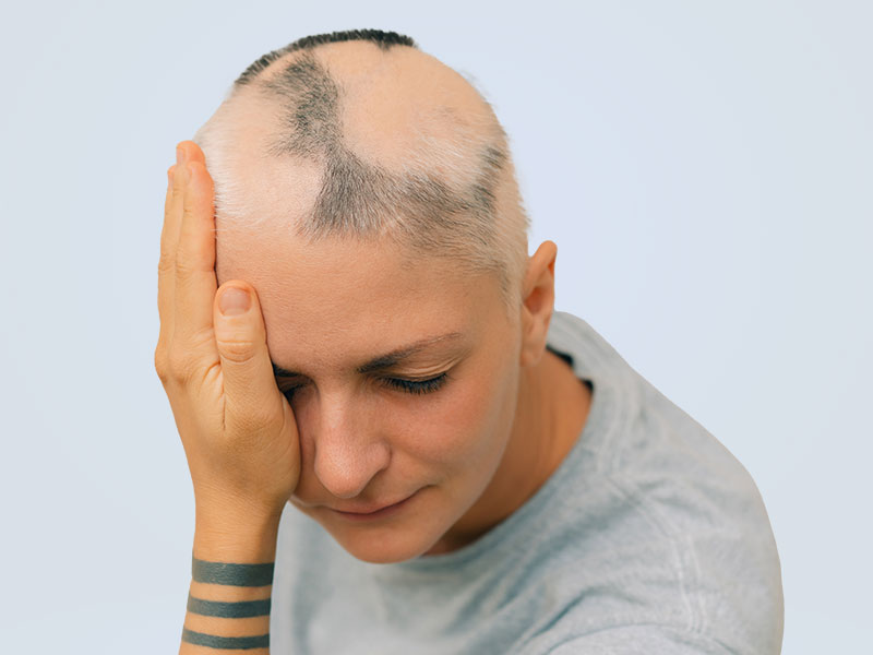 Alopesi Areata